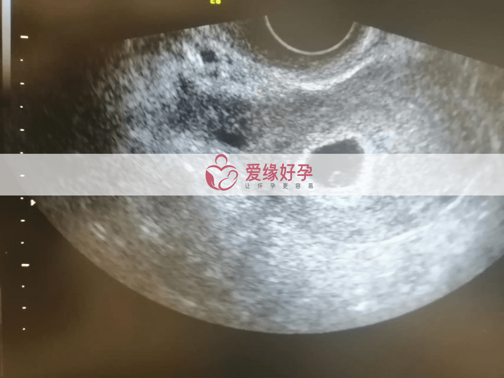 乌克兰试管婴儿助孕爱心妈妈5周产检顺利通过！