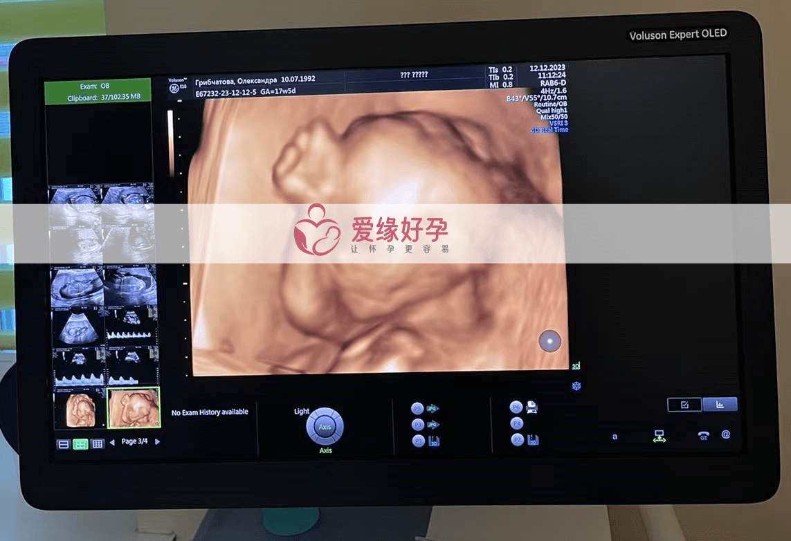 乌克兰试管婴儿爱心妈妈孕18周产检顺利通过