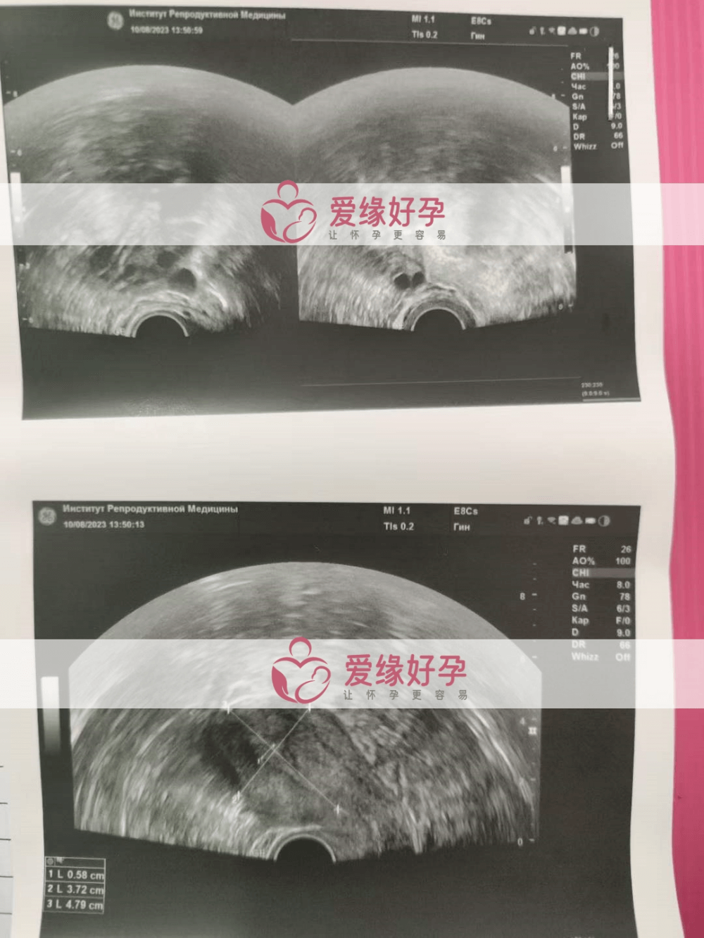 爱缘好孕哈萨克斯坦试管婴儿助孕委托父母就诊