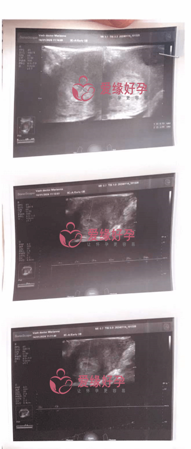爱缘好孕哈萨克斯坦试管婴儿助孕第一次B超顺利通过