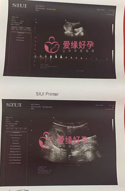 哈萨克斯坦试管婴儿助孕第一次B超检查通过