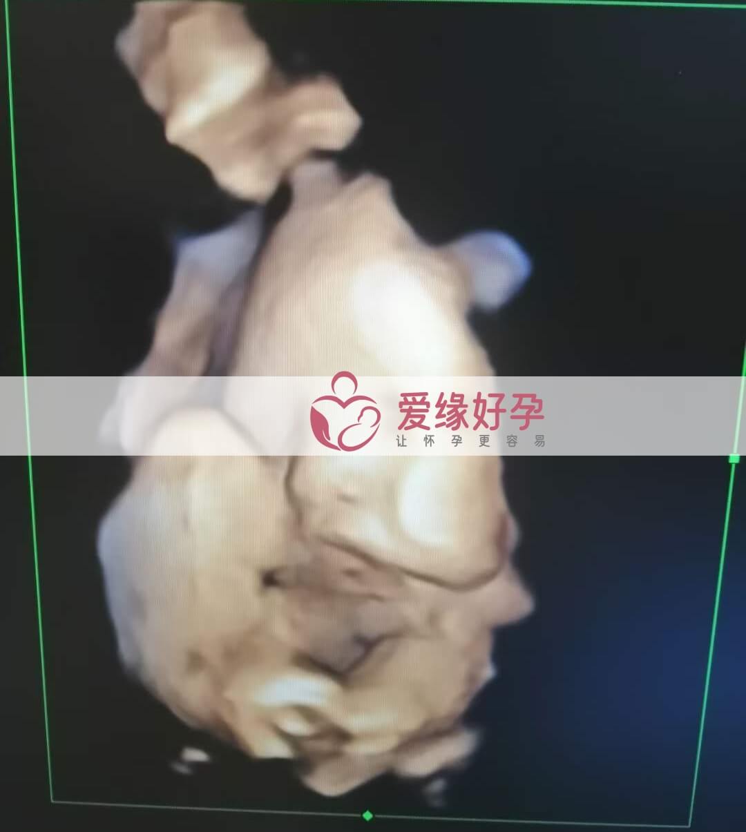 哈萨克斯坦试管婴儿助孕妈妈35周产检顺利通过