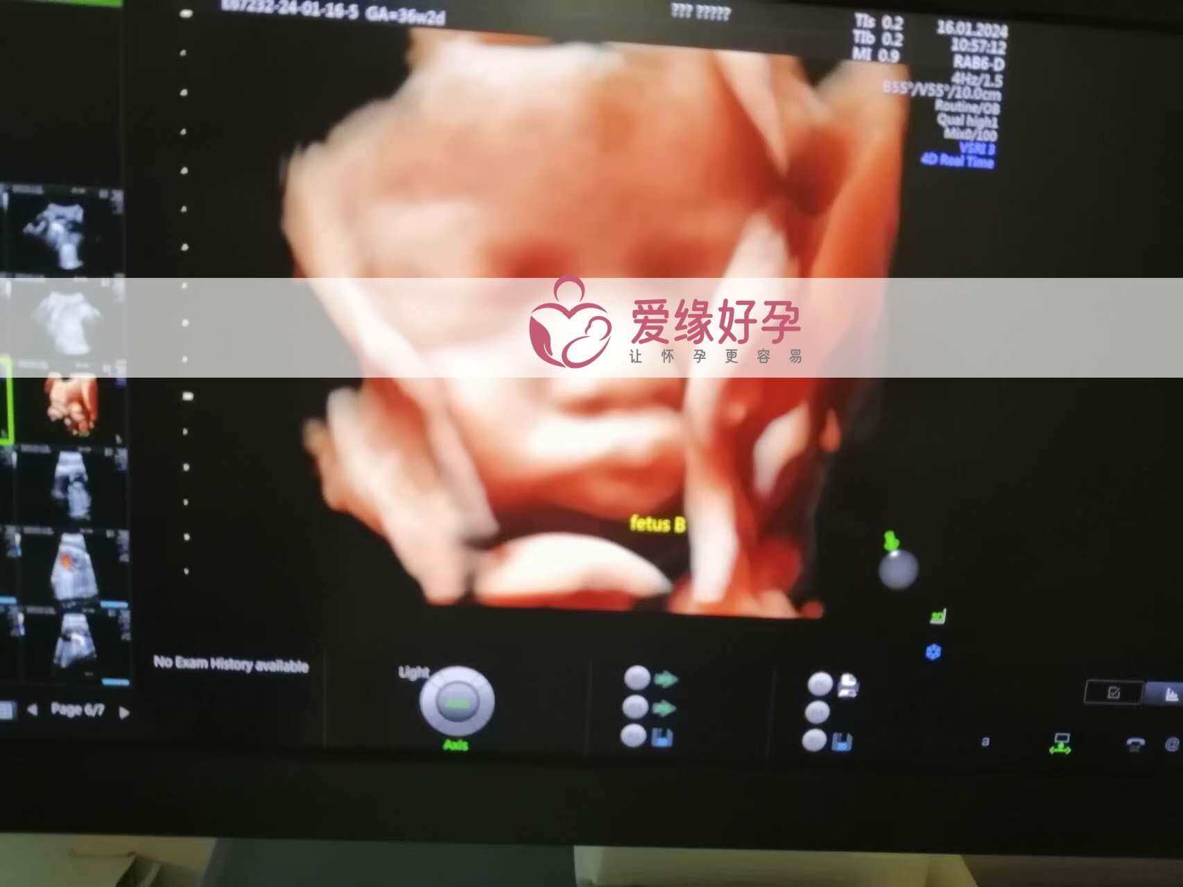 哈萨克斯坦试管婴儿助孕妈妈34周产检通过