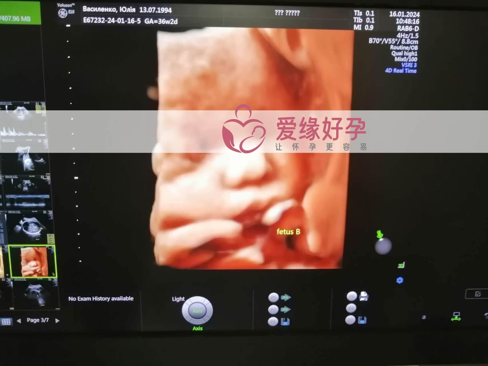 哈萨克斯坦试管婴儿助孕妈妈34周产检通过