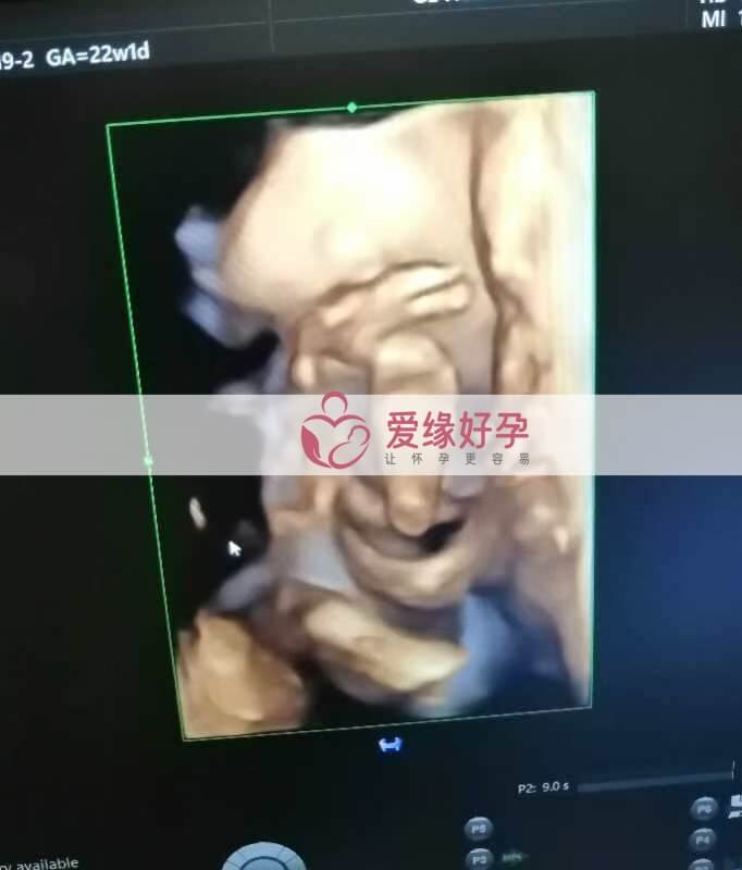 哈萨克斯坦试管婴儿助孕妈妈22周产检通过