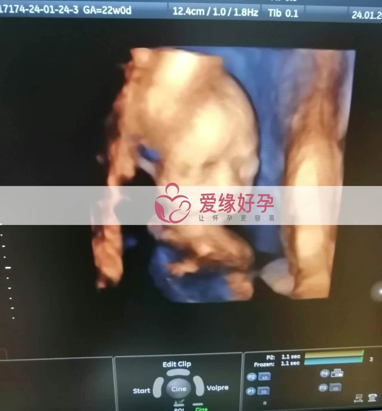 试管婴儿助孕爱心妈妈21周产检顺利通过