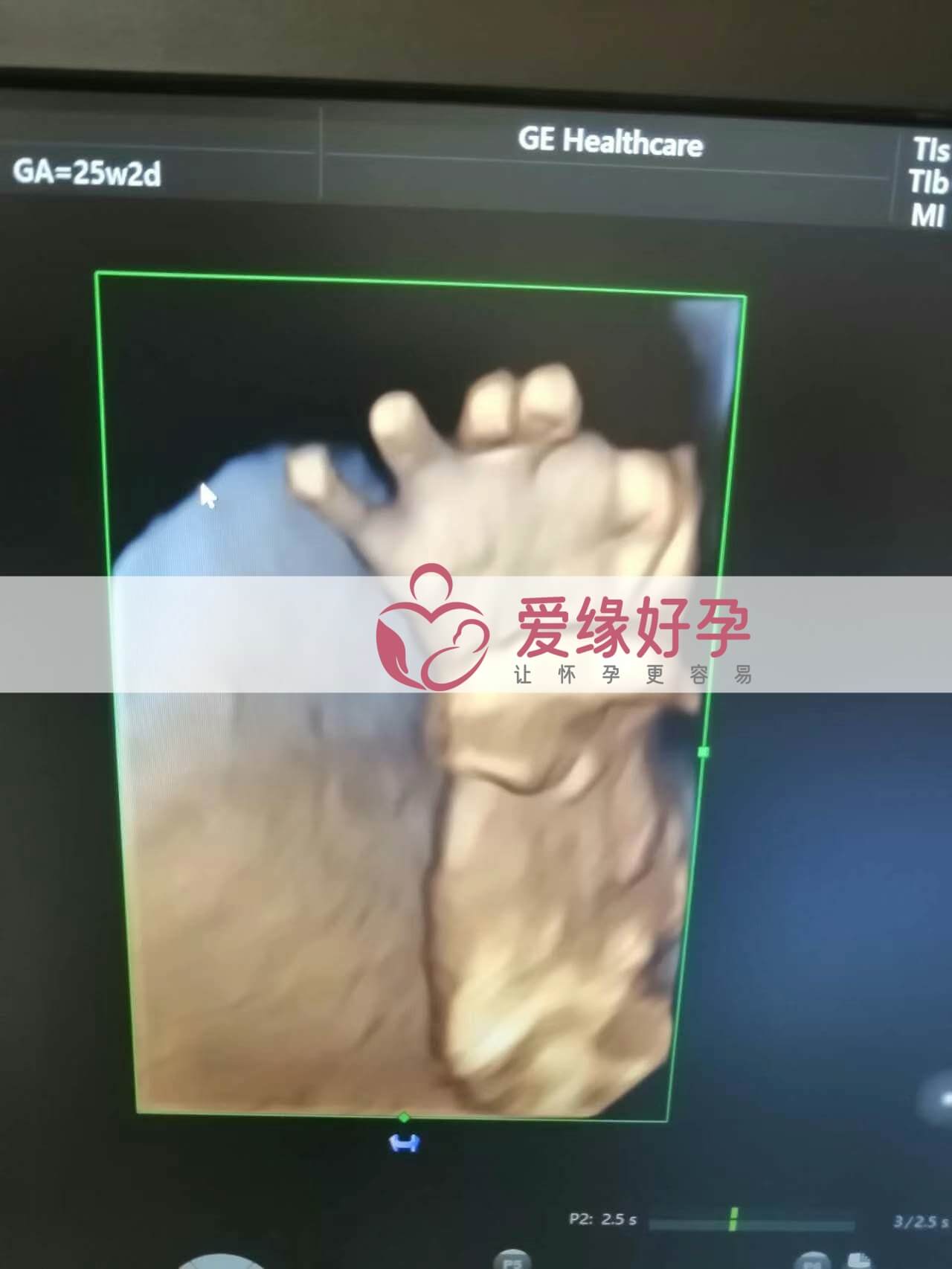 试管婴儿助孕爱心妈妈24周产检顺利通过