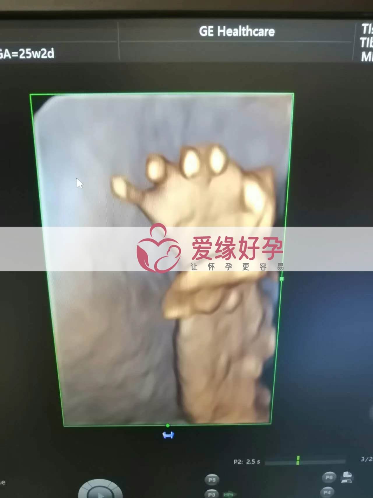 试管婴儿助孕爱心妈妈24周产检顺利通过