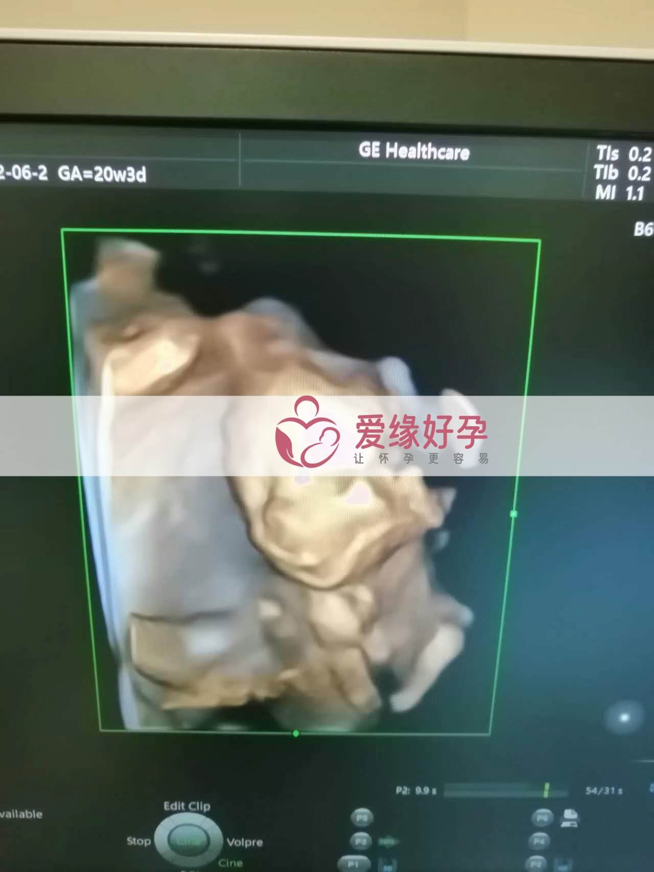 试管婴儿助孕爱心妈妈20周产检顺利通过