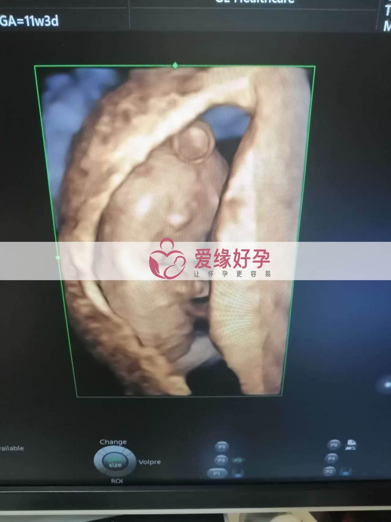 试管婴儿助孕爱心妈妈12周产检顺利通过