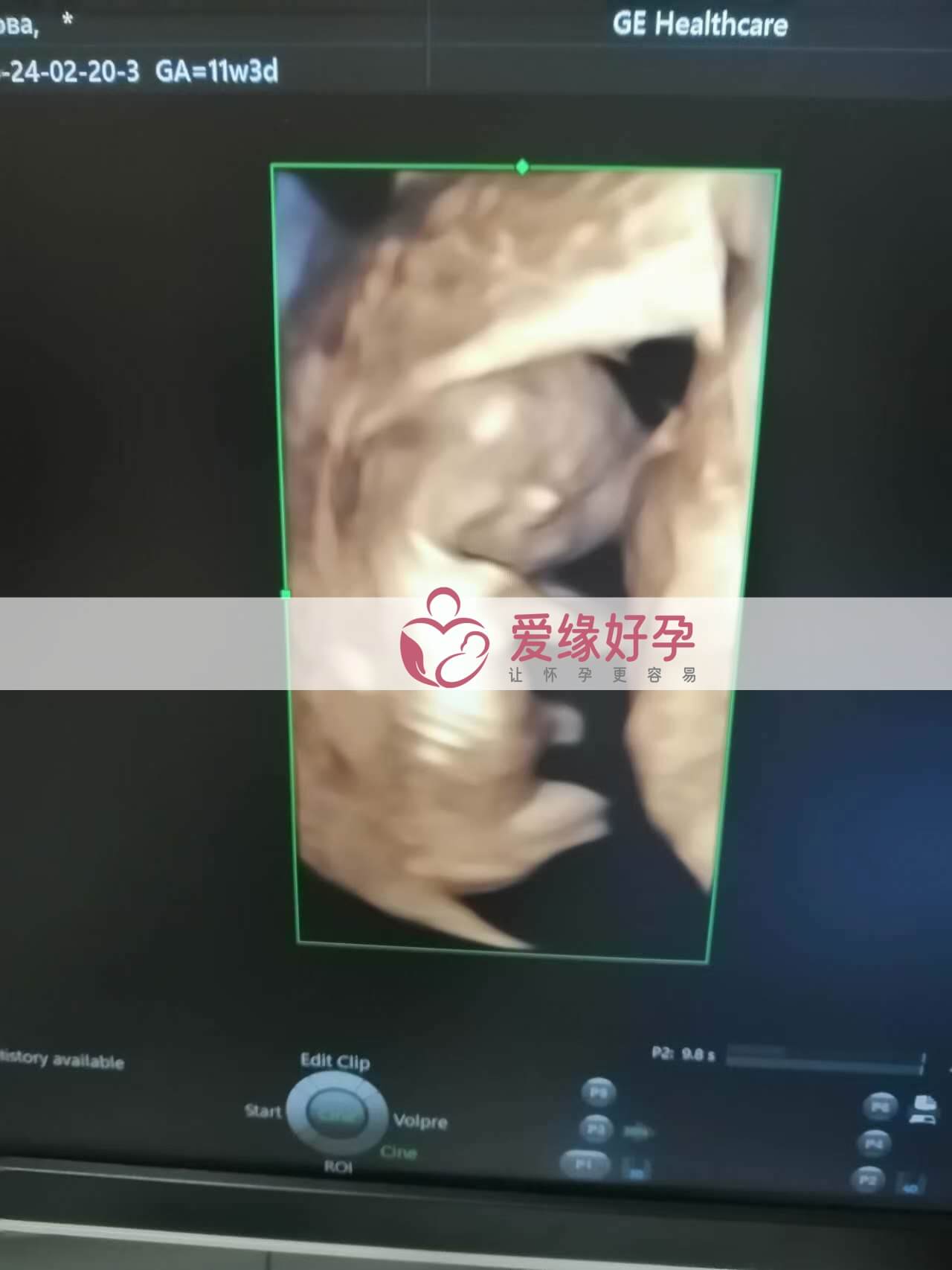 试管婴儿助孕爱心妈妈12周产检顺利通过