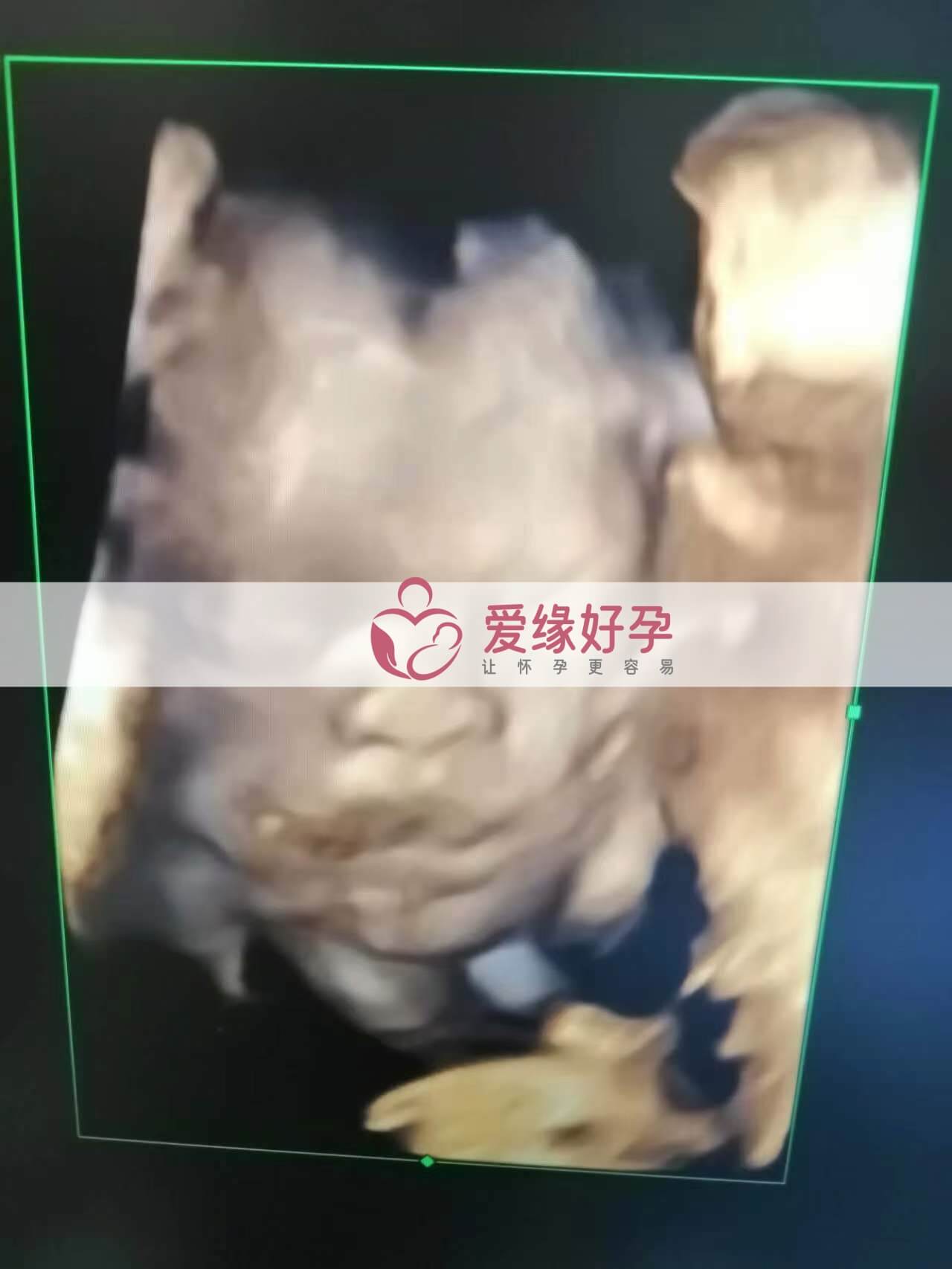 试管婴儿助孕爱心妈妈26周产检顺利通过