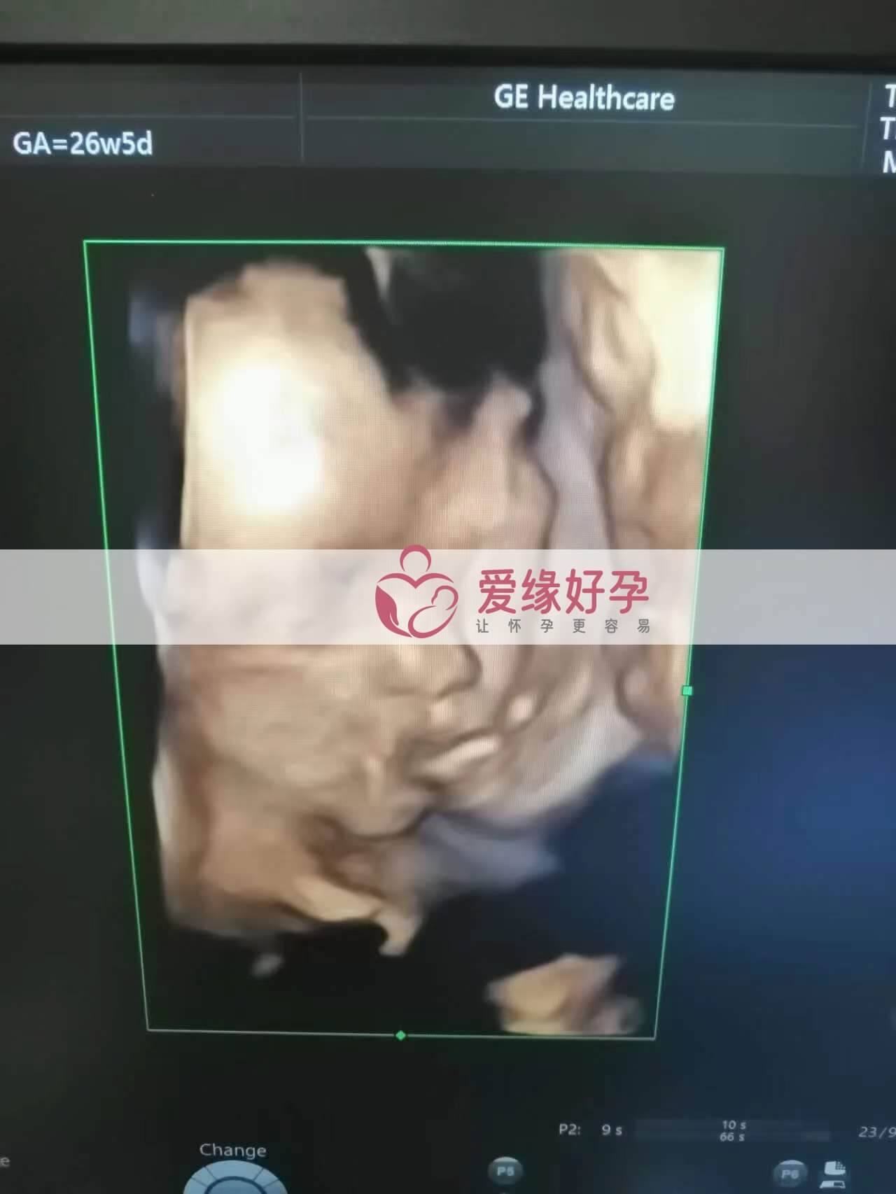 试管婴儿助孕爱心妈妈26周产检顺利通过