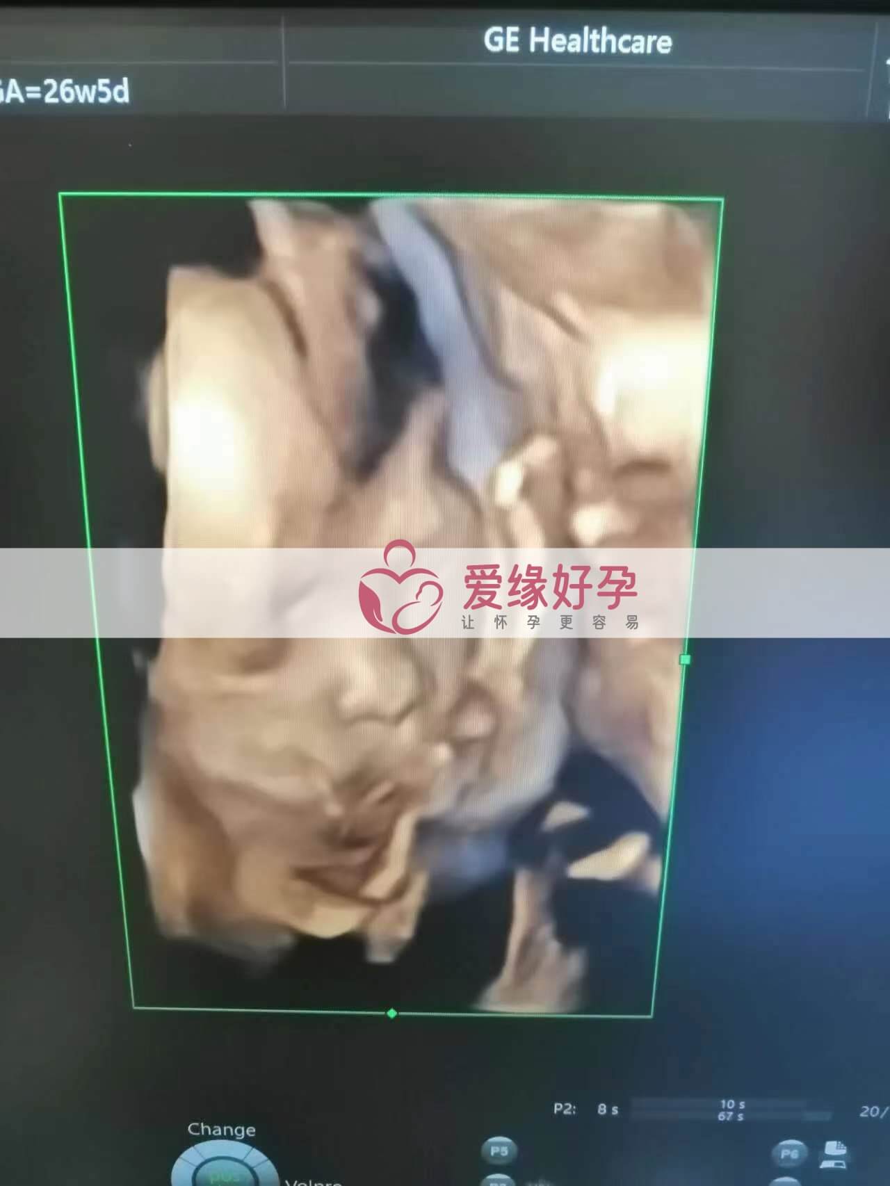 试管婴儿助孕爱心妈妈26周产检顺利通过