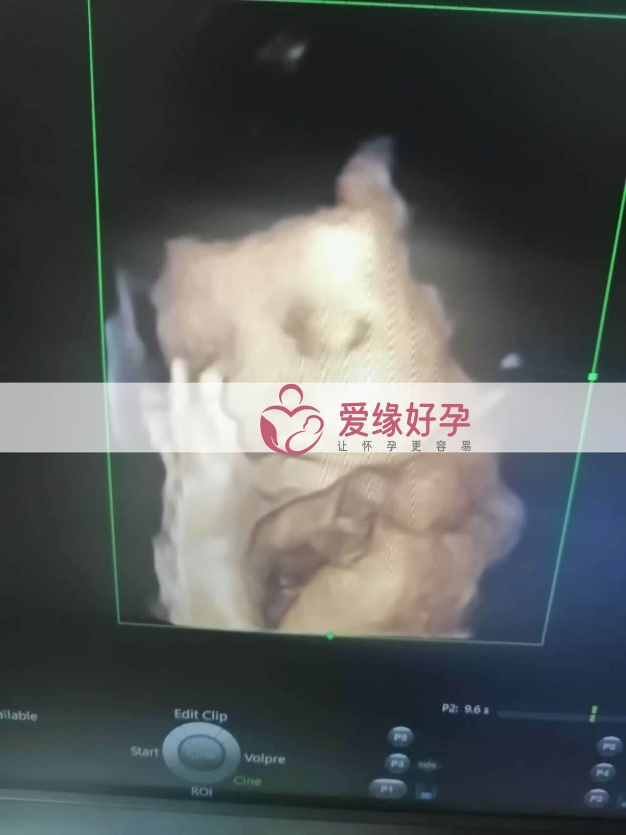 试管婴儿助孕爱心妈妈31周孕检顺利通过