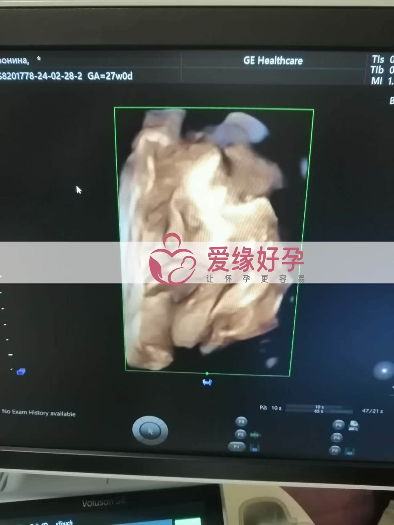 试管婴儿助孕爱心妈妈27周孕检顺利通过