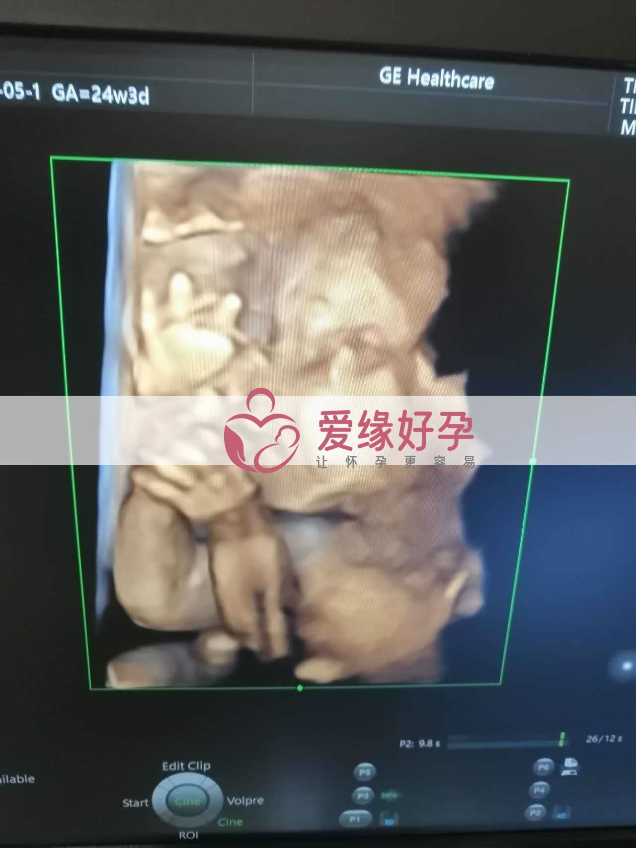 试管婴儿助孕爱心妈妈24周产检顺利通过