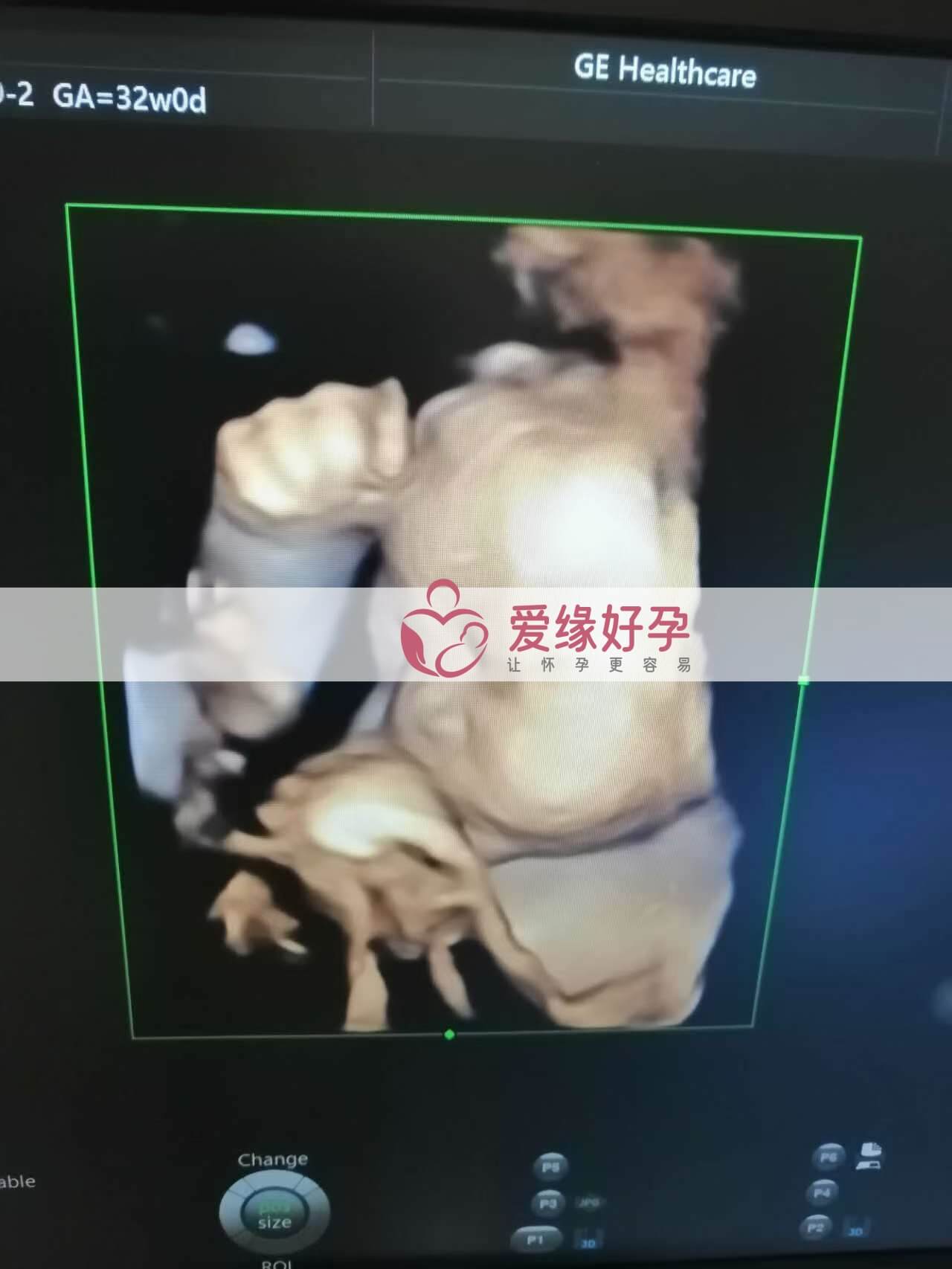 试管婴儿助孕爱心妈妈32周产检顺利通过