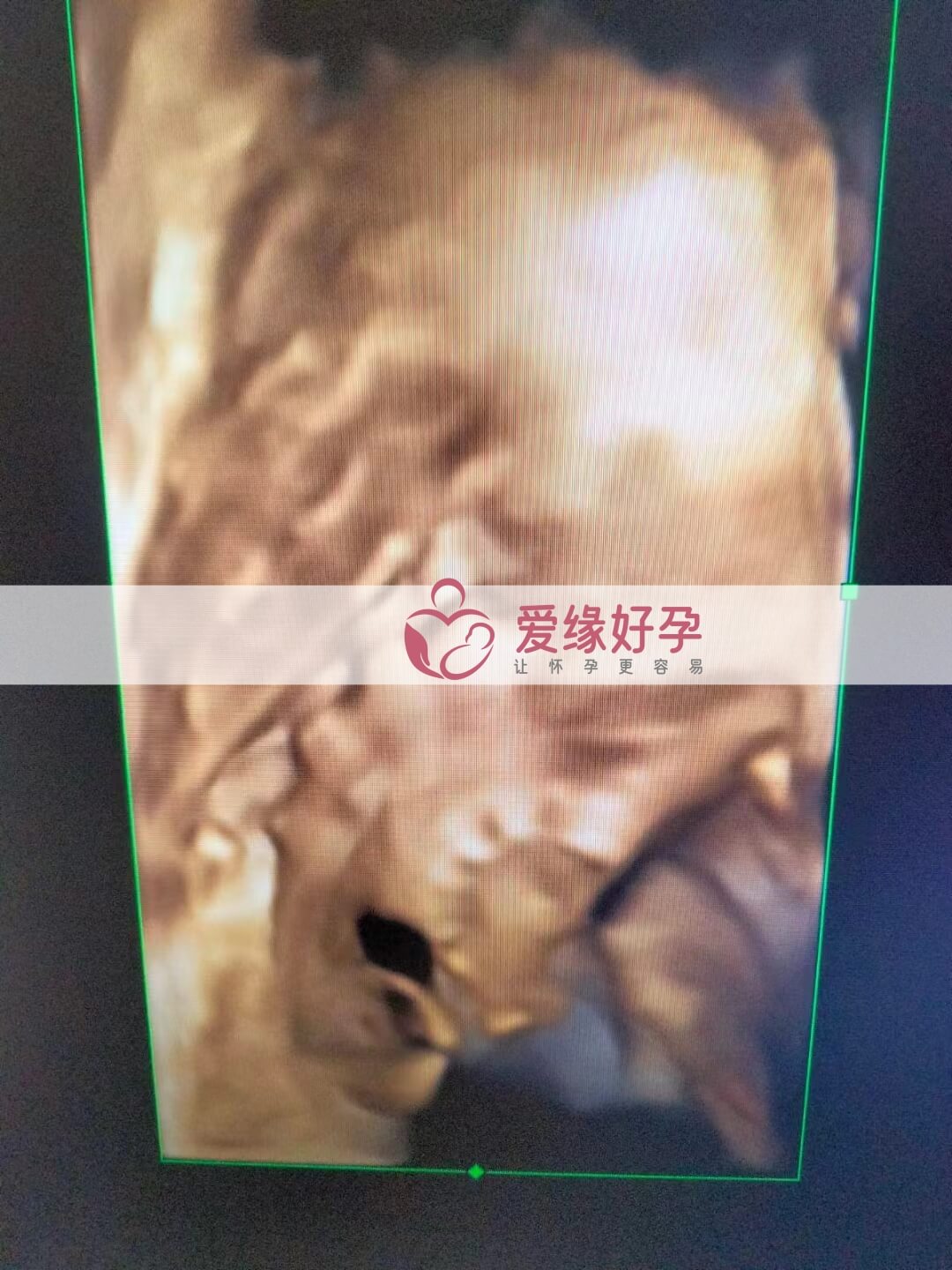 试管婴儿助孕爱心妈妈30周产检顺利通过