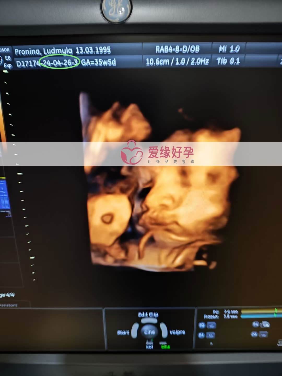 爱缘好孕: 乌克兰爱心妈妈34周孕检顺利通过