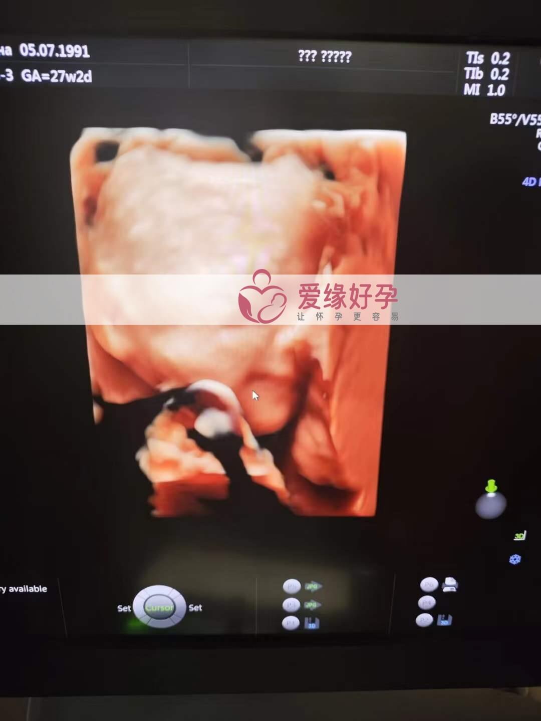 爱缘好孕:乌克兰爱心妈妈孕28周产检顺利通过