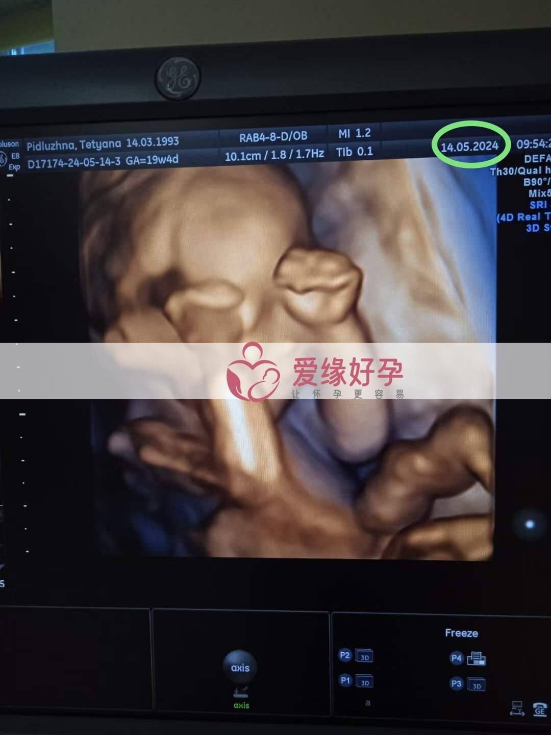 爱缘好孕:乌克兰爱心妈妈18周孕检顺利通过