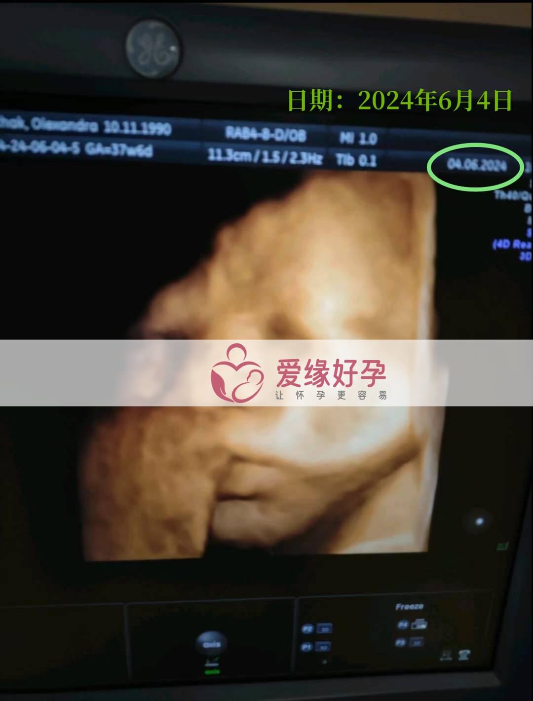 爱缘好孕:乌克兰爱心妈妈孕37周产检顺利通过