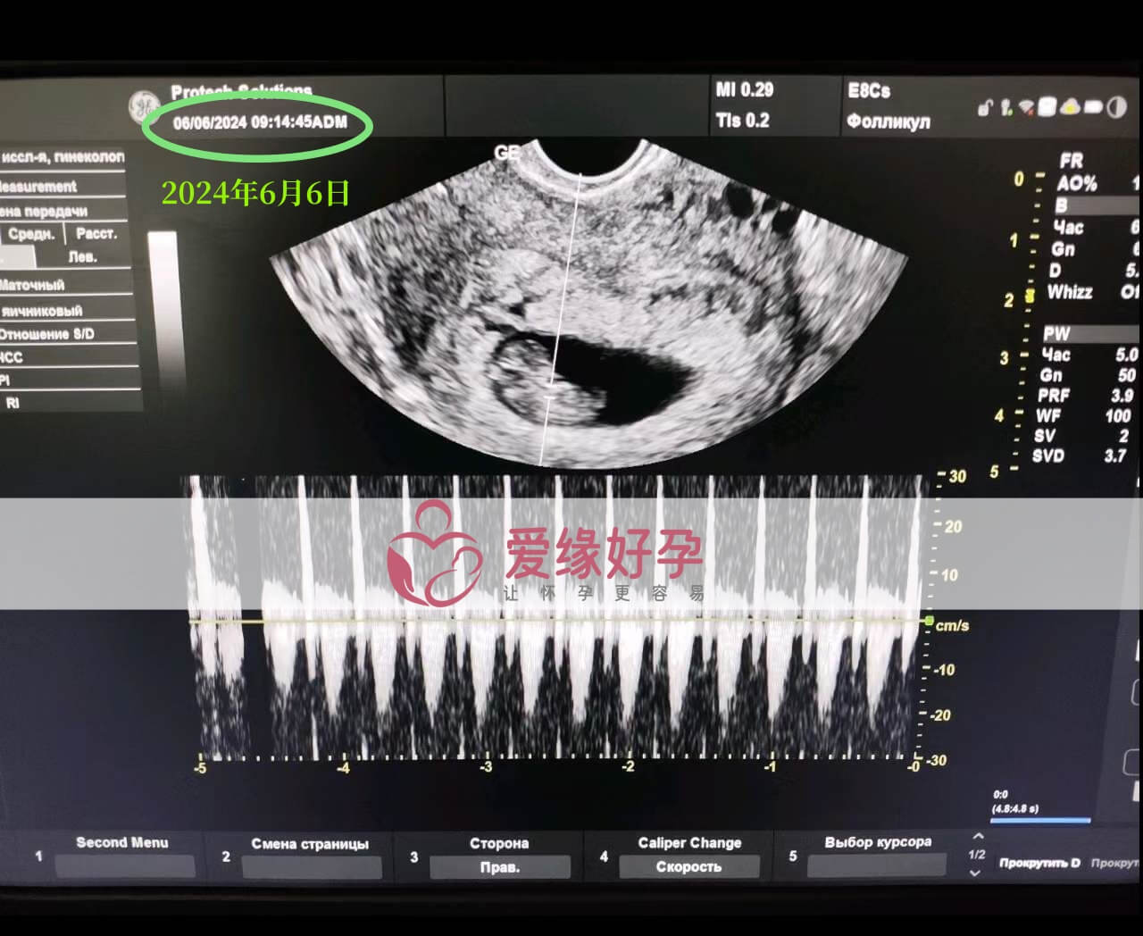爱缘好孕:乌克兰爱心妈妈孕8周产检顺利通过