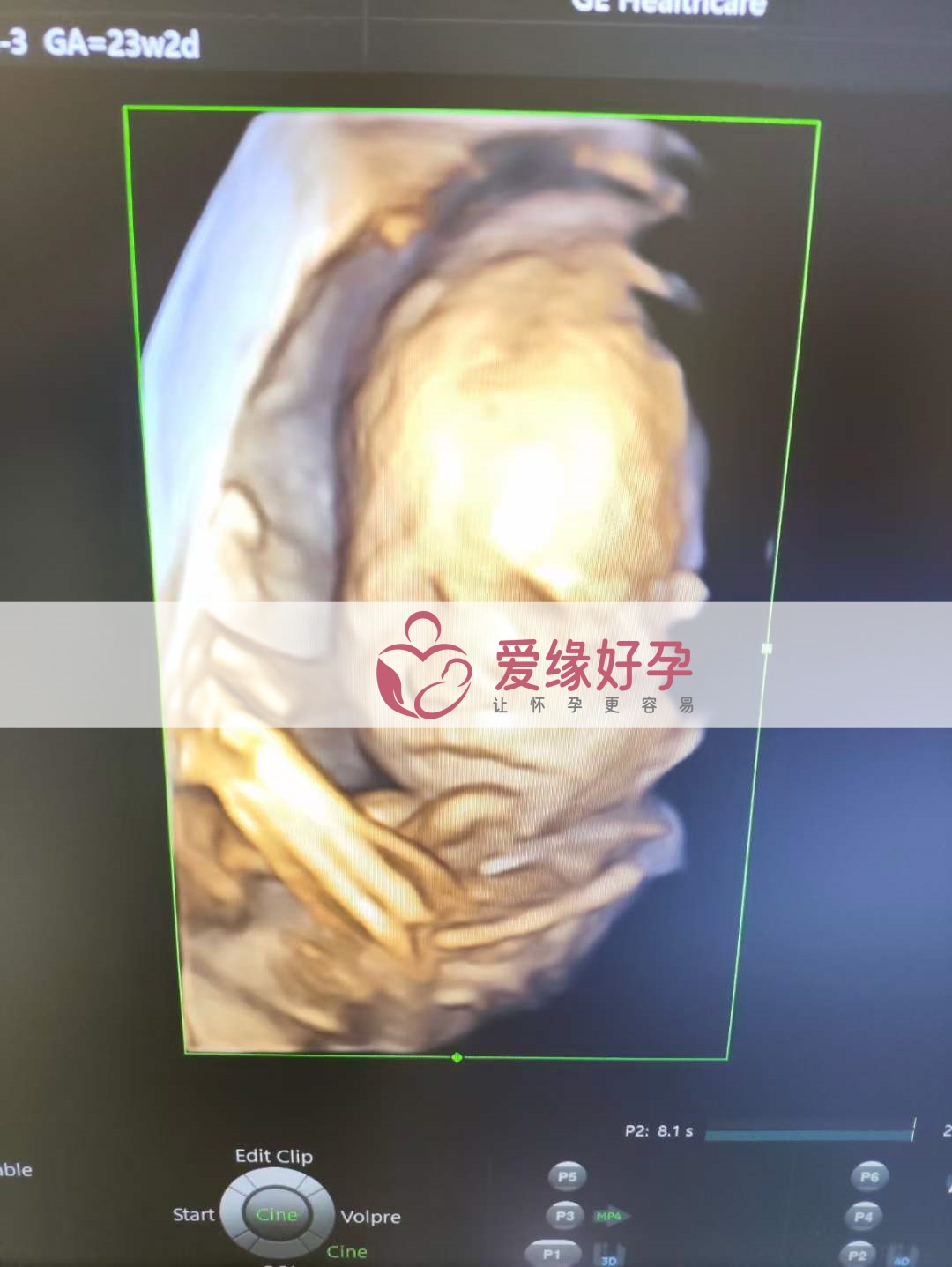 爱缘好孕:乌克兰爱心妈妈孕23周产检顺利通过