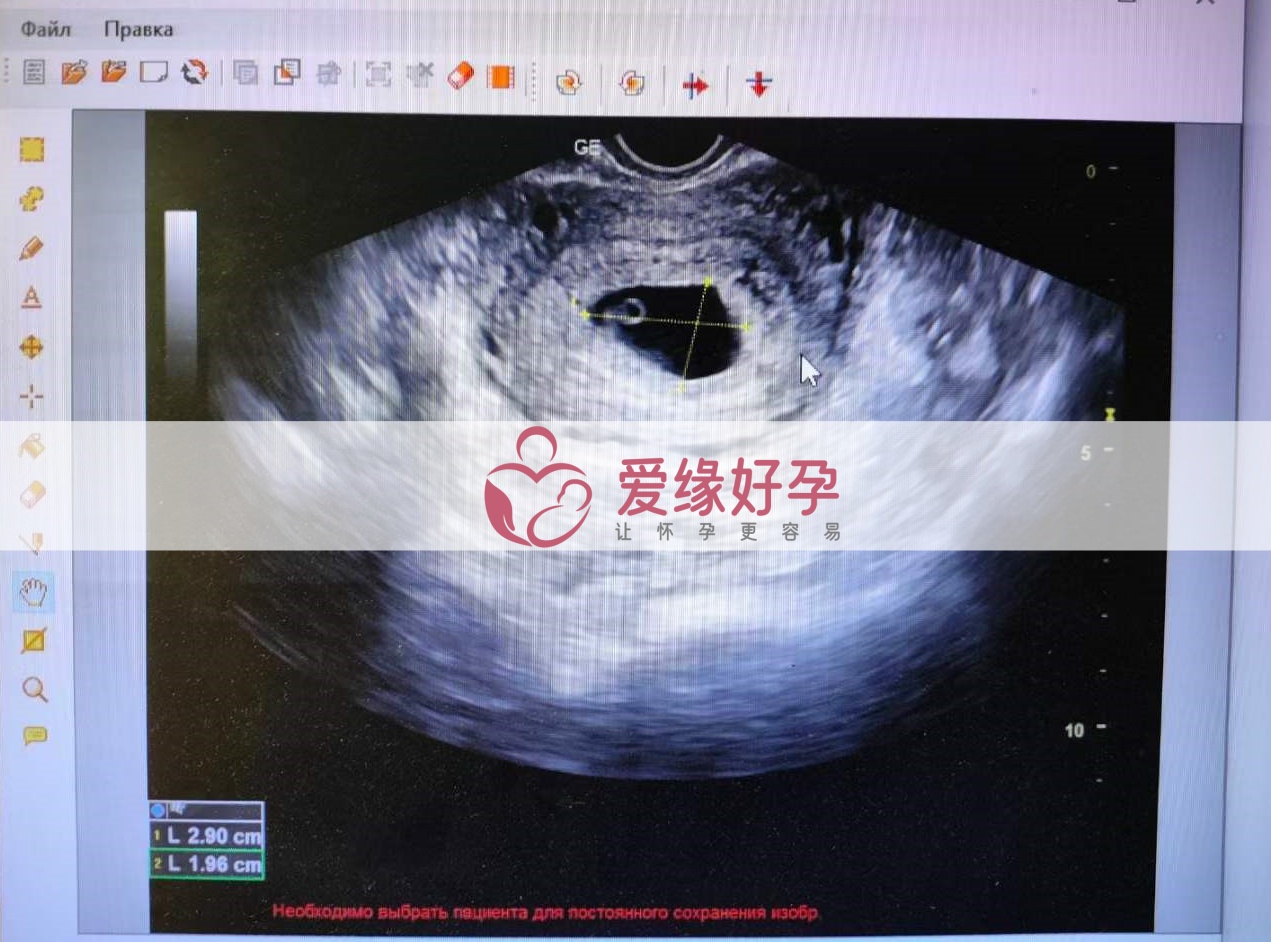 爱缘好孕乌克兰爱心妈妈第一次B超产检顺利通过