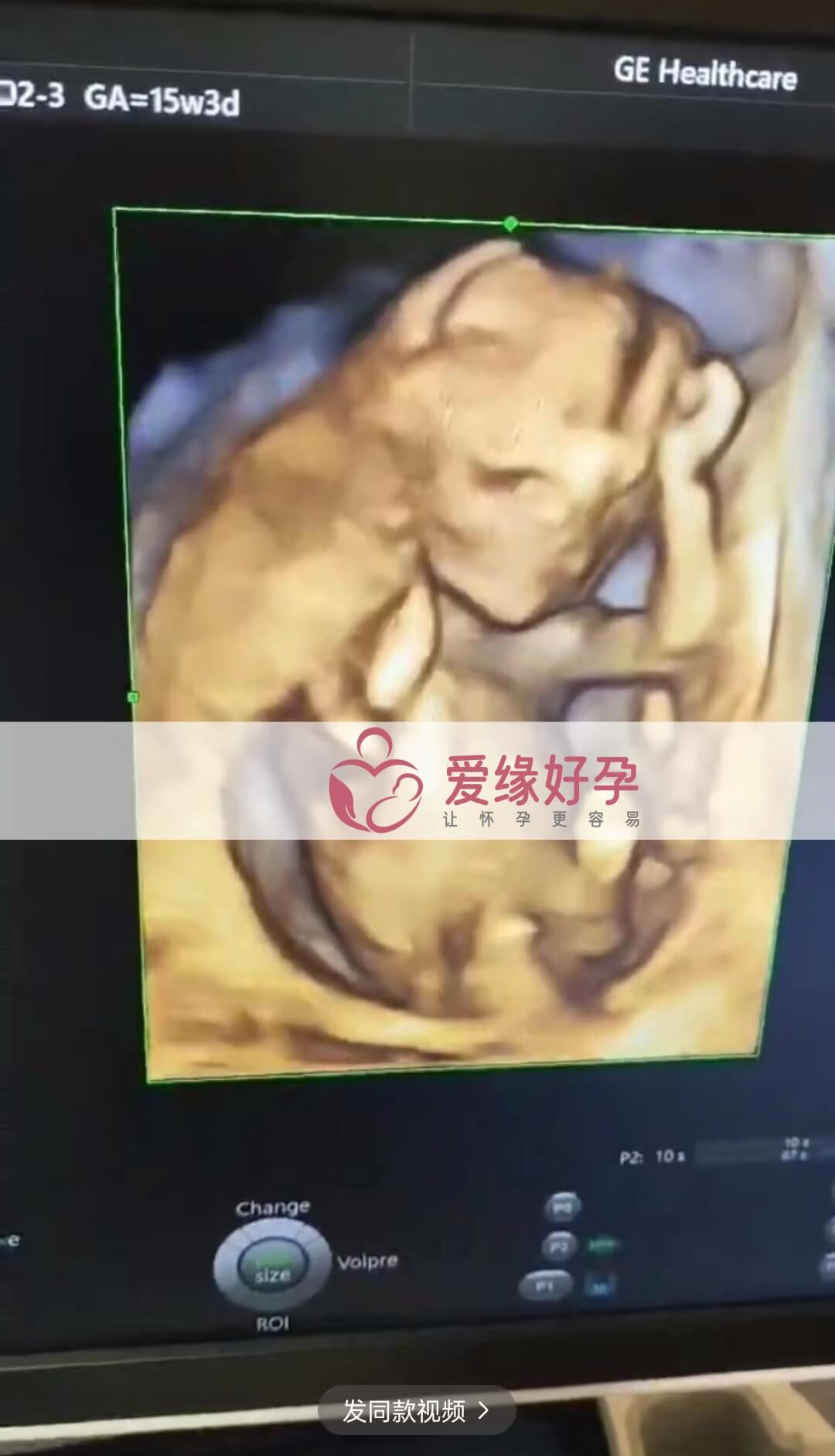 爱缘好孕乌克兰爱心妈妈孕15周产检顺利通过