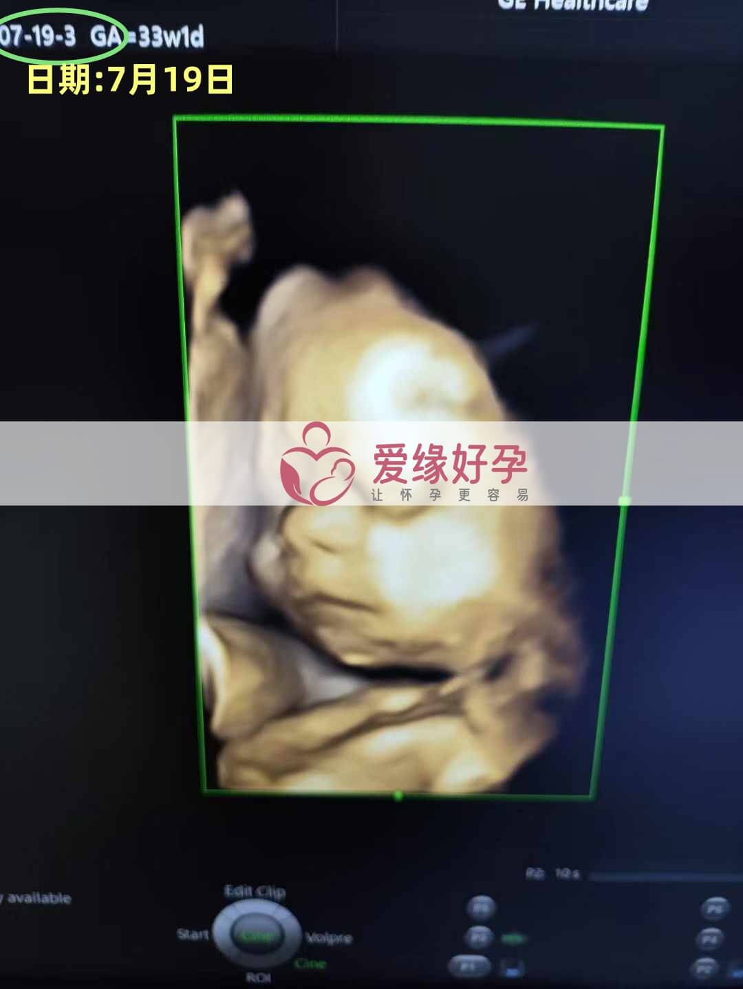 爱缘好孕乌克兰爱心妈妈孕34周产检顺利通过