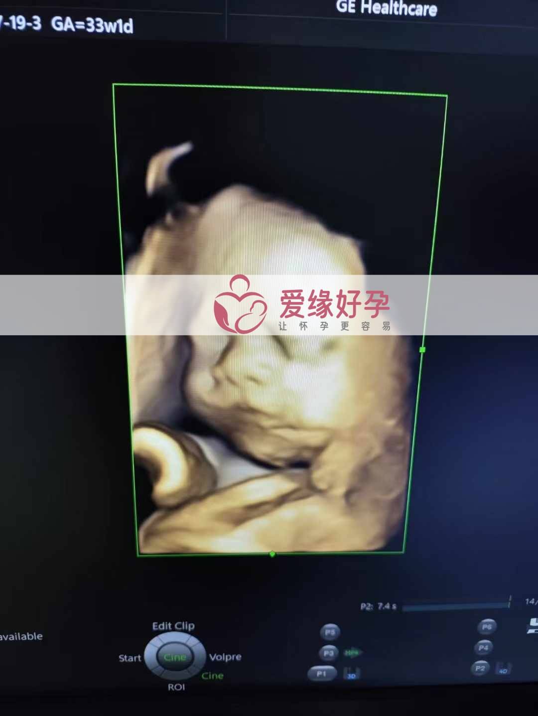 爱缘好孕乌克兰爱心妈妈孕34周产检顺利通过