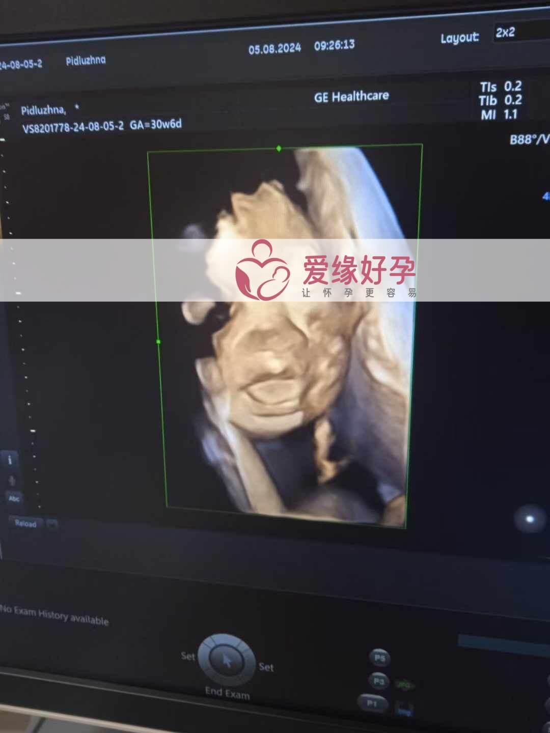 爱缘好孕乌克兰爱心志愿者30周孕检通过！