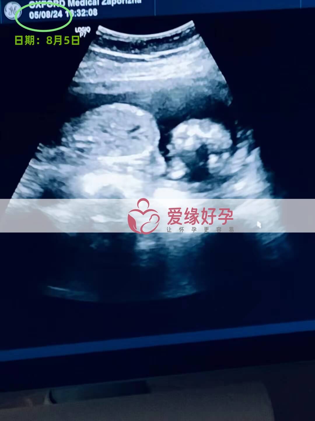 爱缘好孕乌克兰爱心志愿者17周孕检通过！