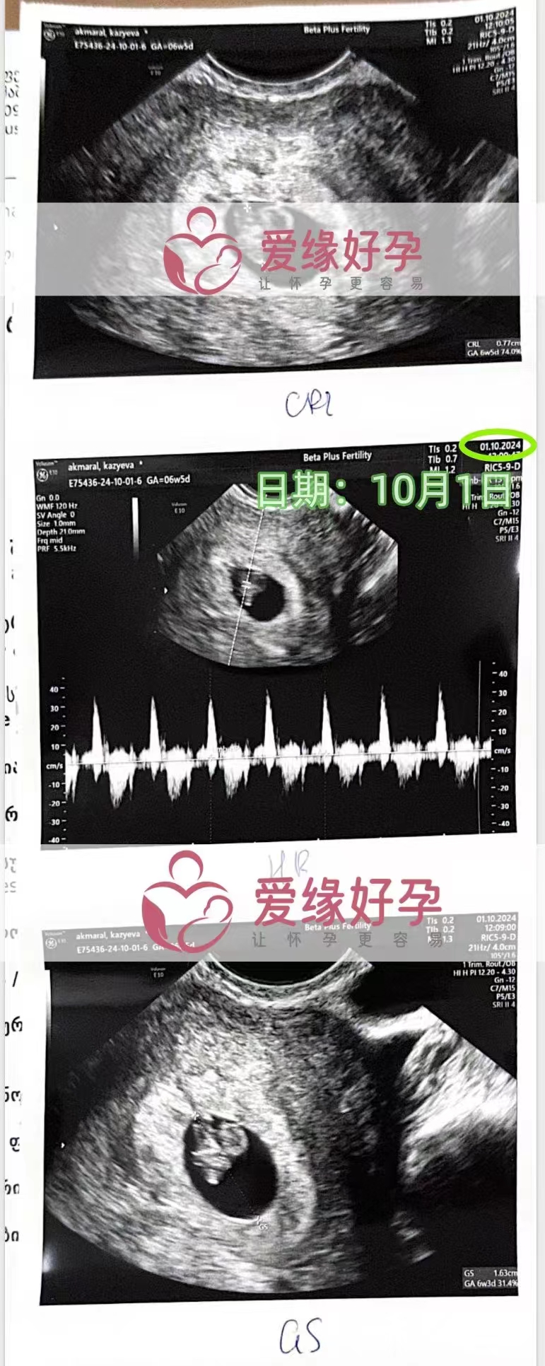 格鲁吉亚爱心使者孕6周产检顺利通过