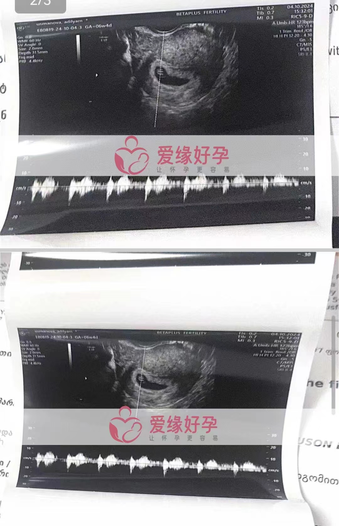 格鲁吉亚爱心使者的双胞胎孕6周产检顺利通过