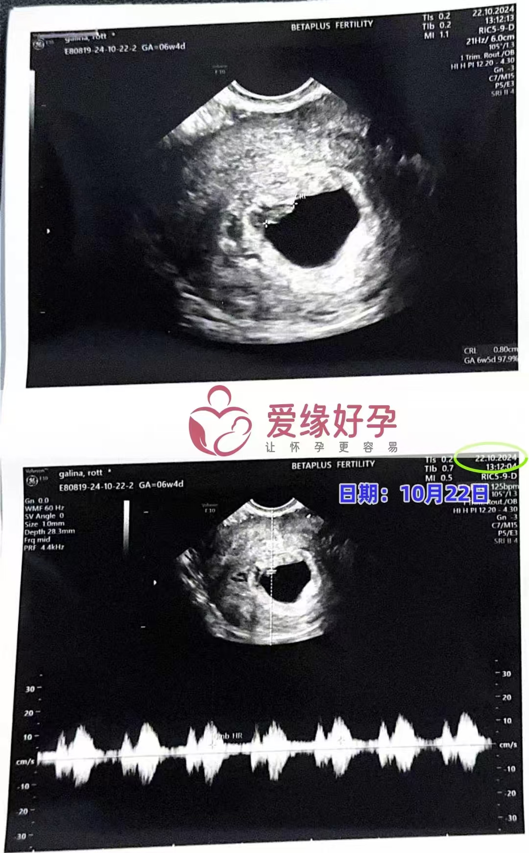 格鲁吉亚爱心使者孕6周产检顺利通过