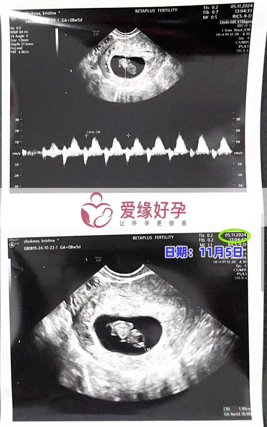 格鲁吉亚爱心使者孕8周产检顺利通过