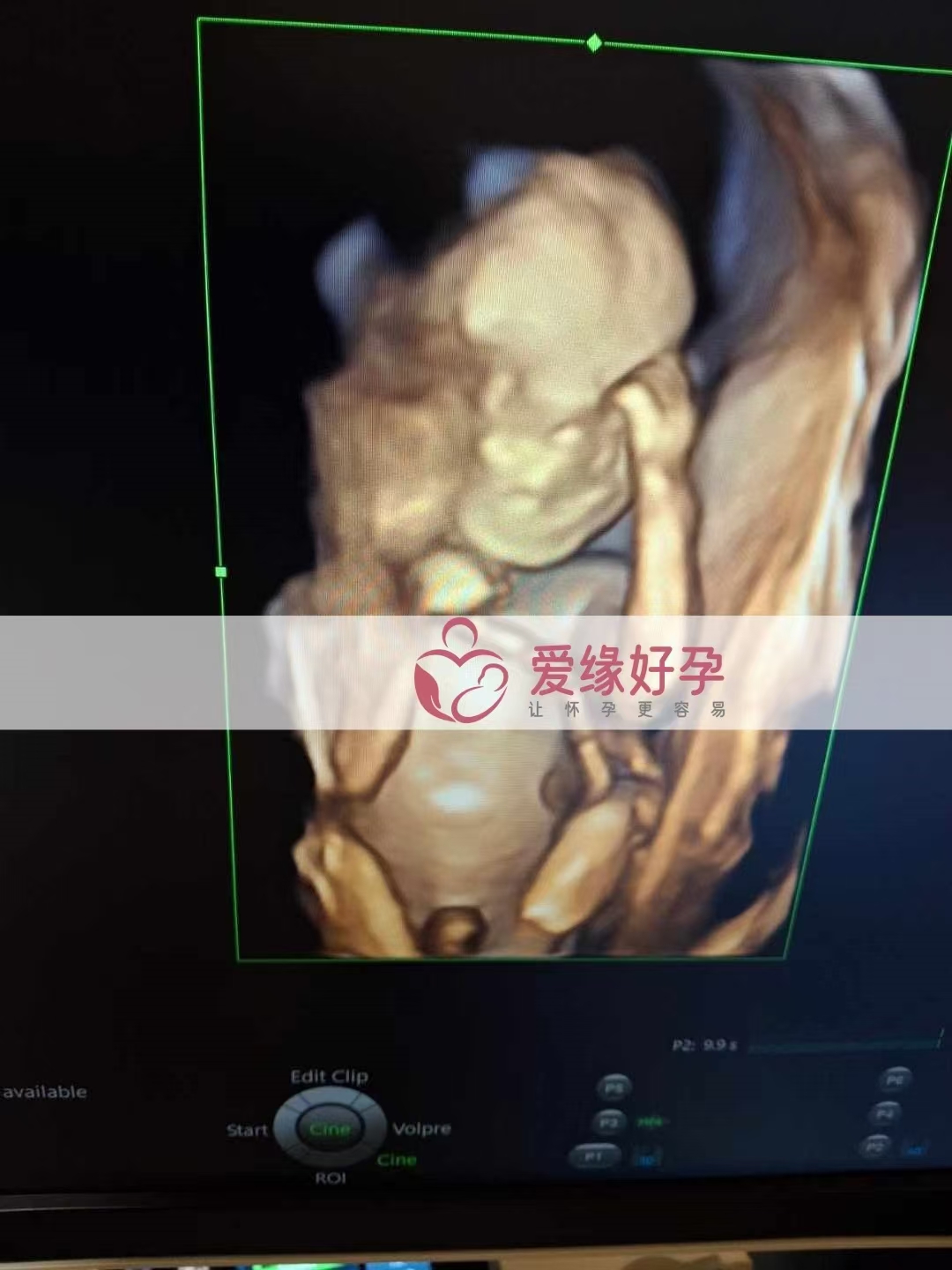 乌克兰爱心使者孕19周产检顺利通过