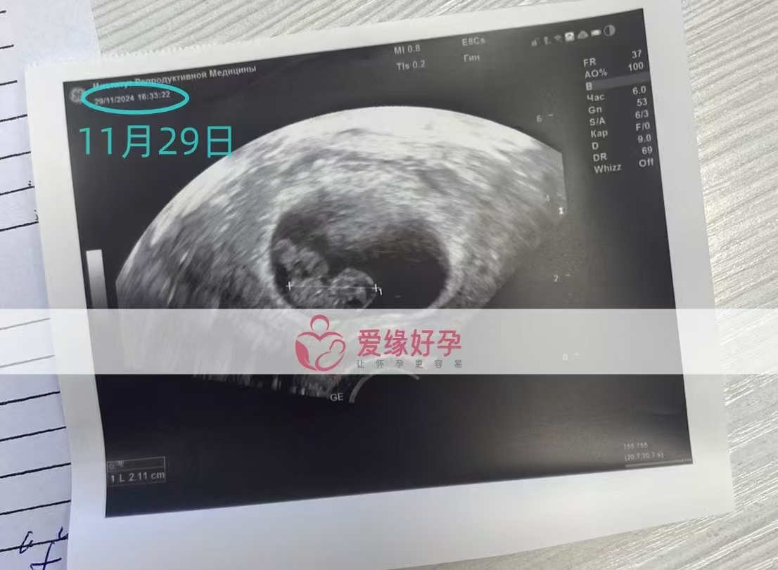 哈萨克斯坦爱心使者孕后2次B超检查顺利通过